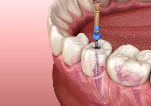 Endodoncias o tratamiento de conductos