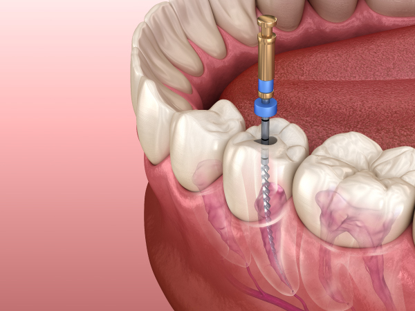 Endodoncias o tratamiento de conductos